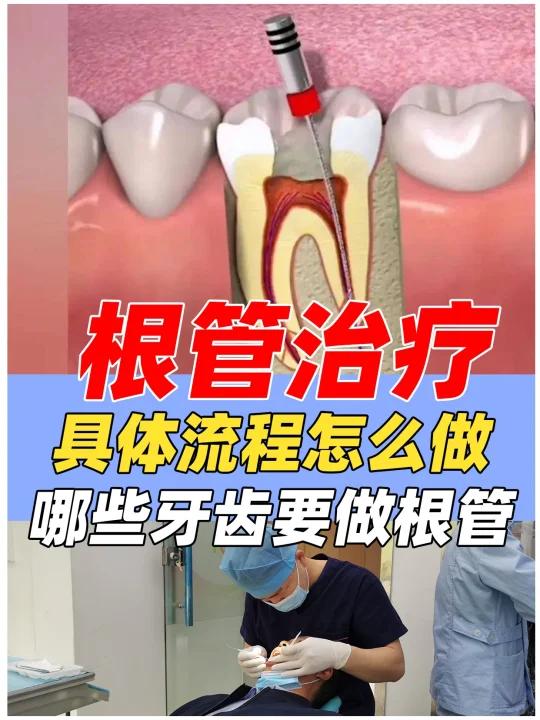 哪些牙齿要做根管治疗,根管流程是什么样?