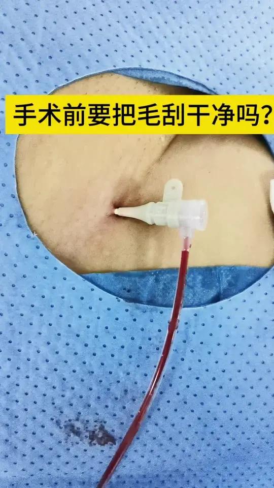 备皮咋备?