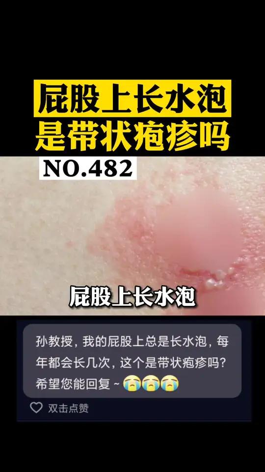 水泡疱疹是因为什么原因引起的