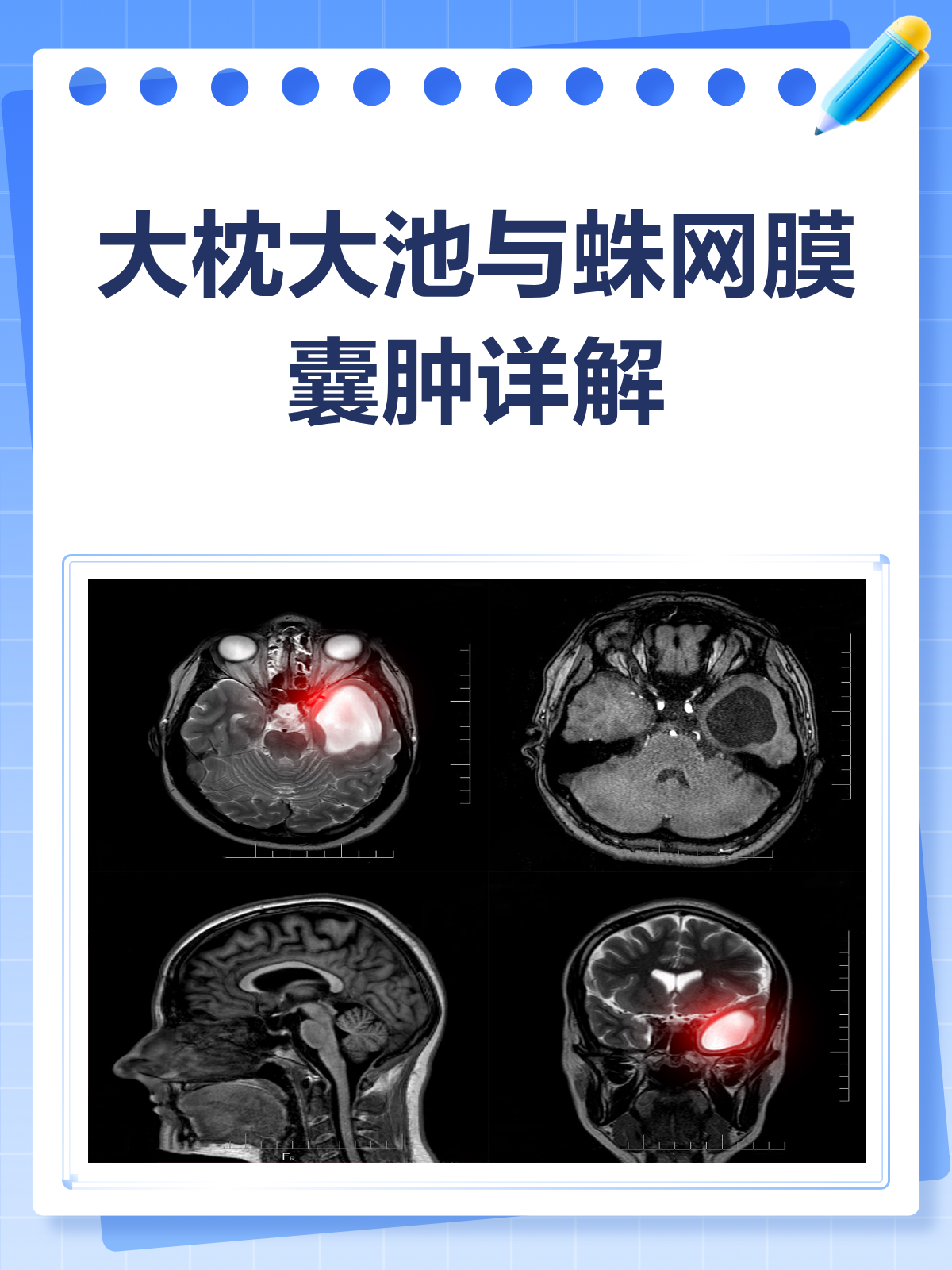 大枕大池&蛛网膜囊肿,一文读懂它们是啥!