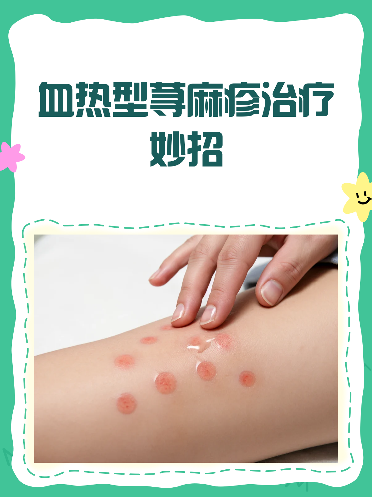 血热型荨麻疹怎么办?有效治疗看这里!