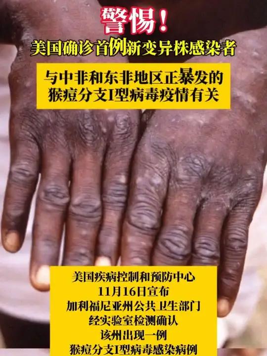 美国确诊首例新变异株感染者!