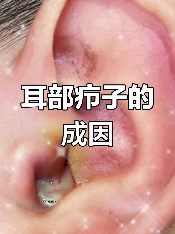 耳朵里的神奇疖子