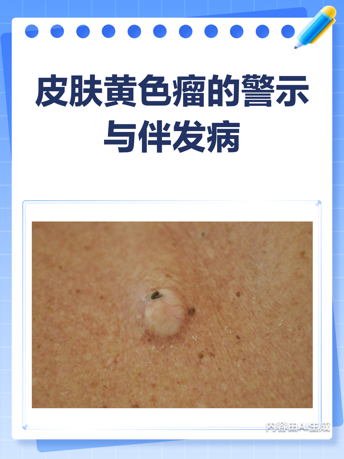 皮肤黄色瘤?可能是身体在报警!