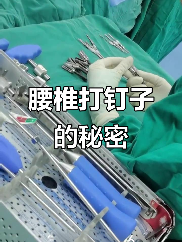腰椎手术打钉子,编号竟是为了这个原因