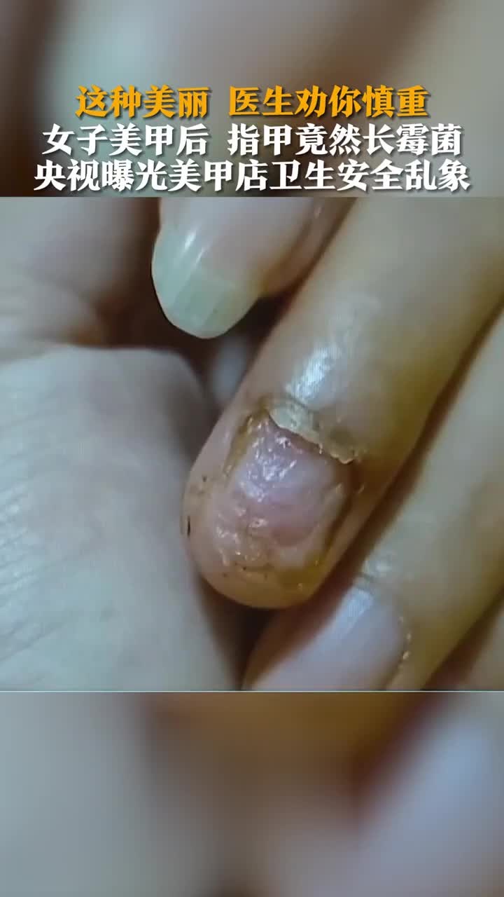 1月19日,有消费者称美甲后,指甲长了霉菌.这种美丽,医生劝你慎重!
