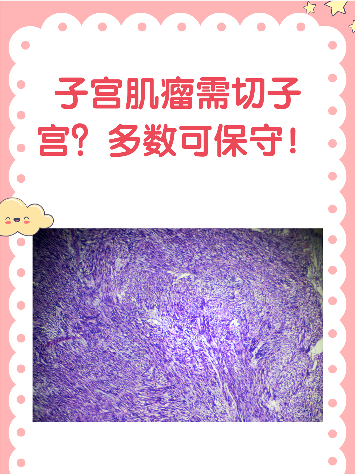 子宫肌瘤为什么要切除子宫