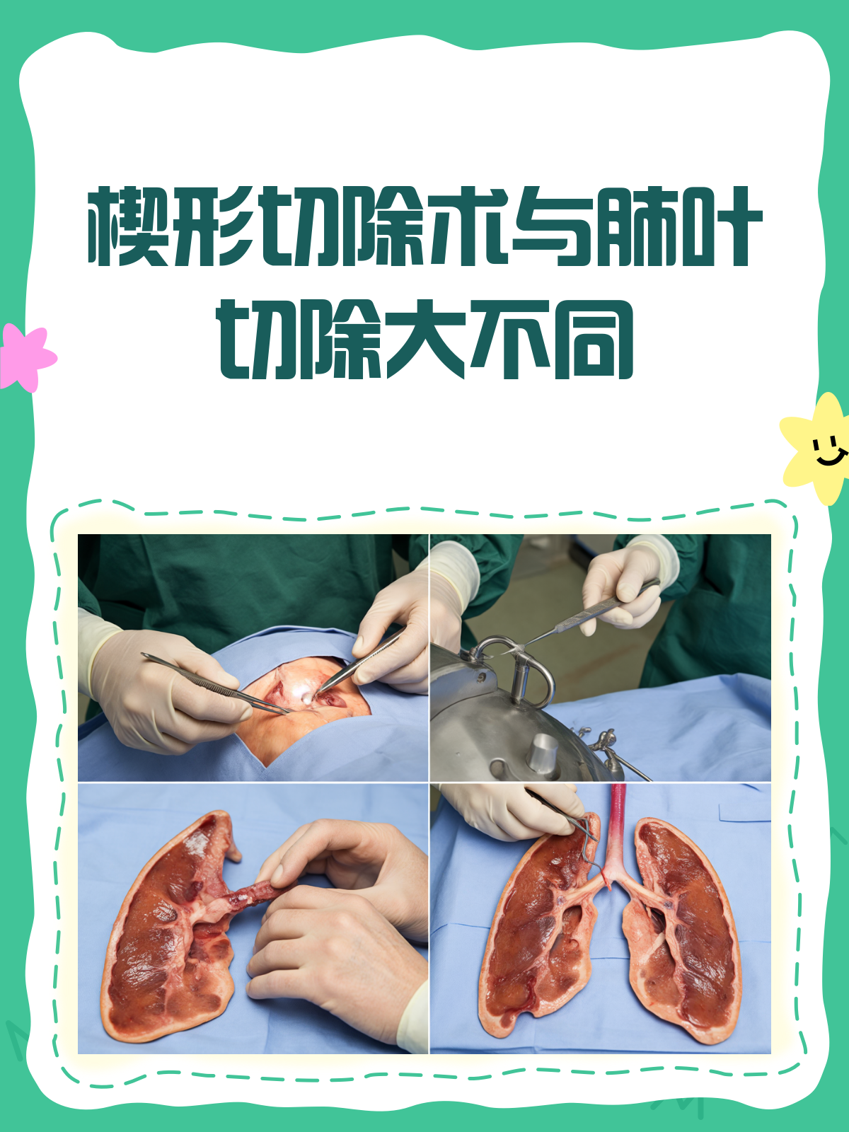 楔形切除术vs肺叶切除,一文看懂两者区别!