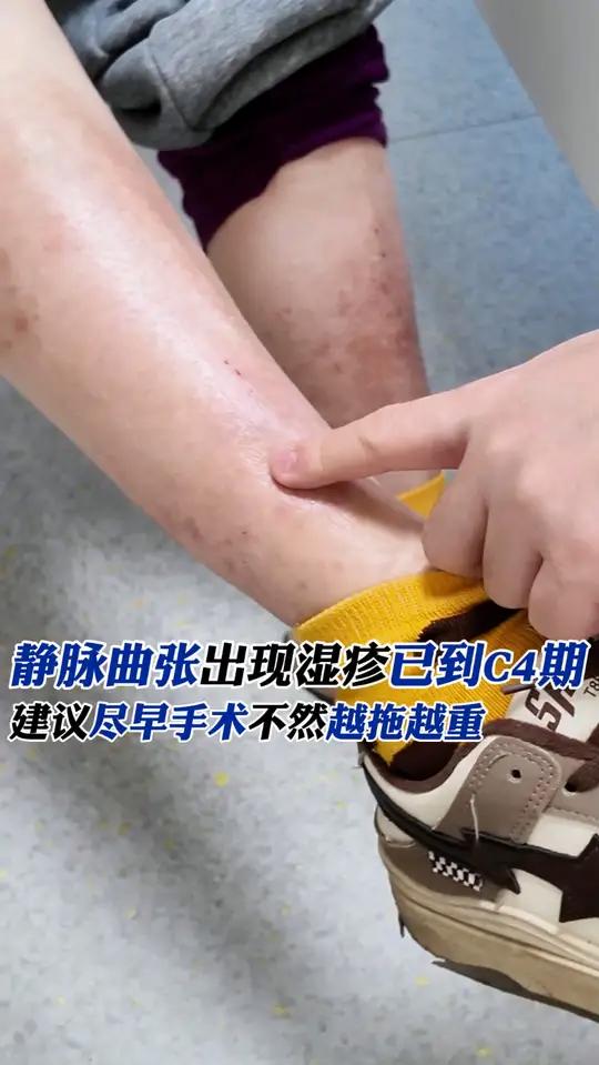 静脉曲张出现湿疹已到c4期,建议尽早手术不然越拖越重