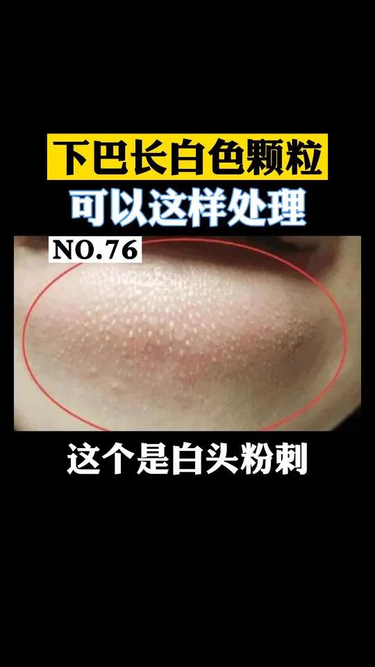 下巴长白头粉刺,可以这样处理白头粉刺粉刺皮肤护肤