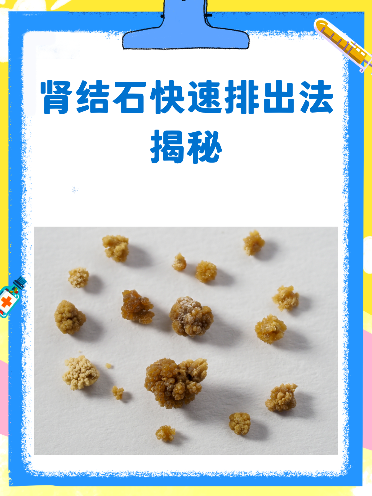 肾结石怎么办?这样排出最快!