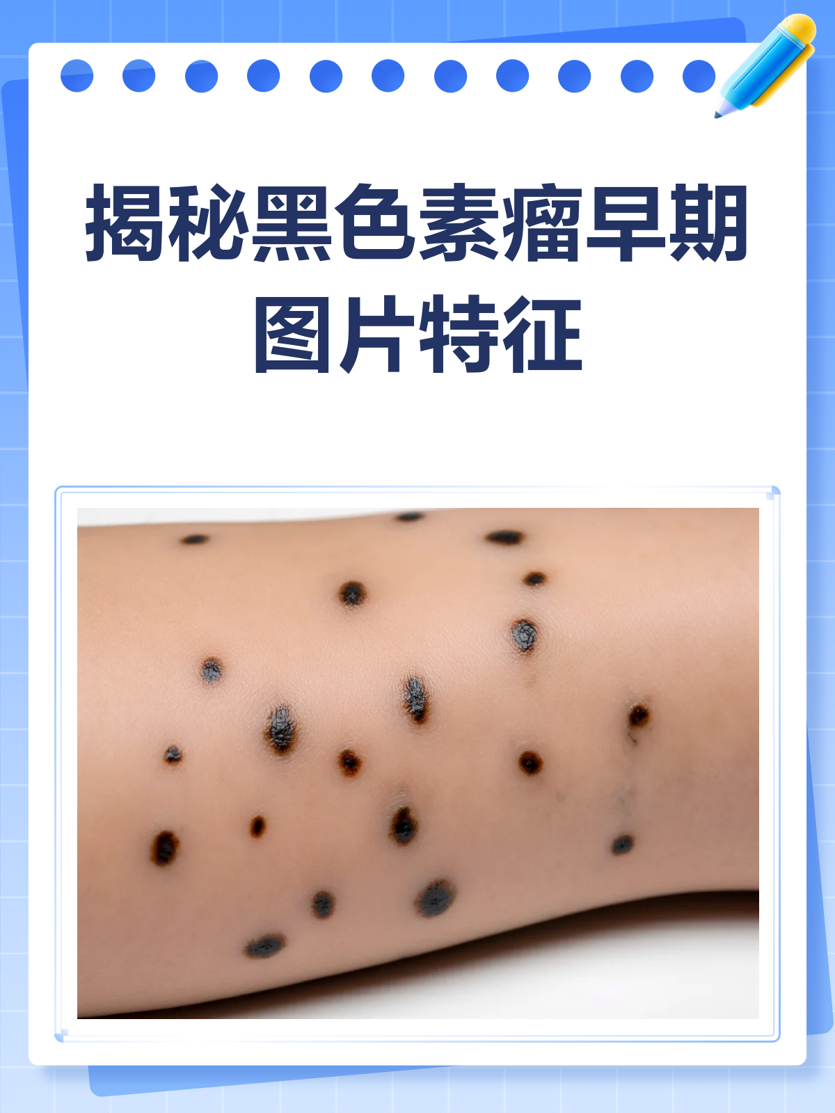 警惕!黑色素瘤早期图片揭秘