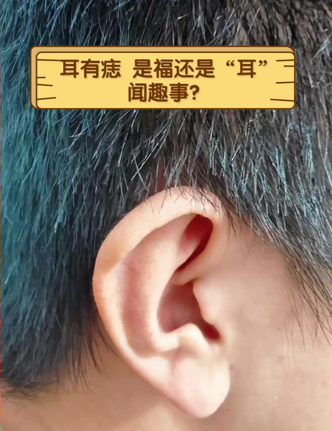 耳有痣,是福还是"耳"闻趣事?