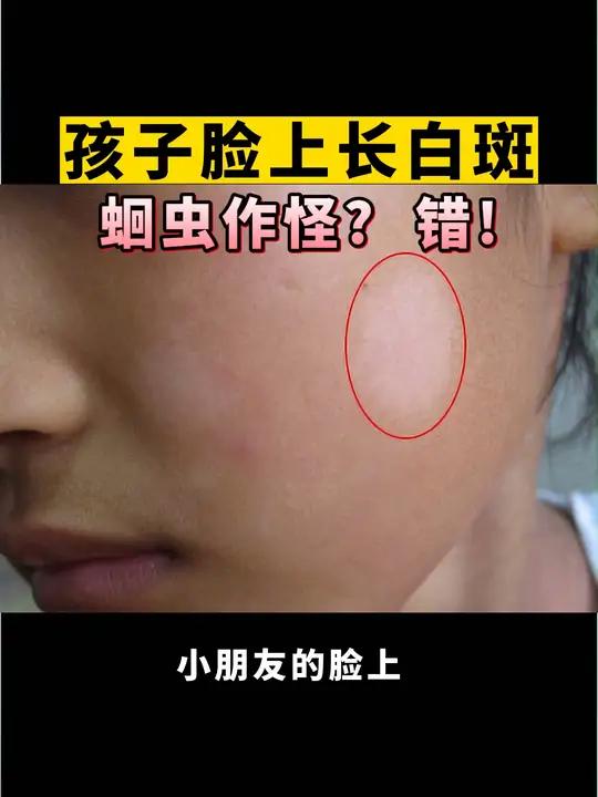 孩子脸上长白斑,是长蛔虫了吗