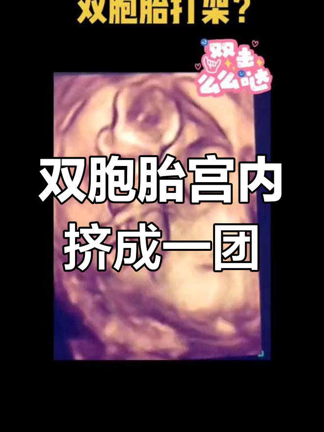 单绒单羊双胞胎,宫内"拥挤"瞬间大揭秘!