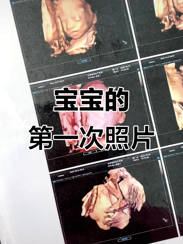 宝宝第一张照片,四维彩超下的美丽瞬间