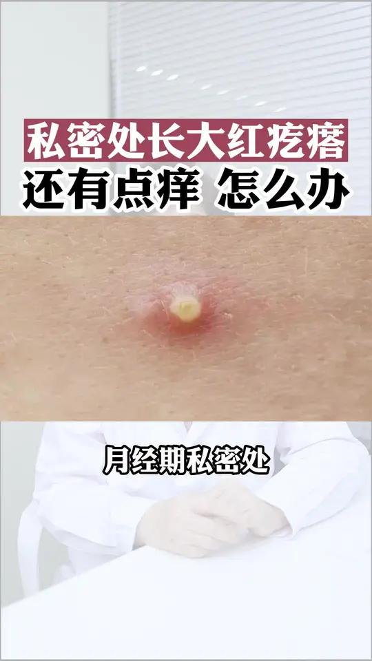 女生月经期,私处长又大又红的疙瘩,这是 外阴毛囊炎,应该这样处理
