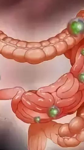 肠道不好,少吃4肉,常喝3水,戒掉2习,肠道更健康
