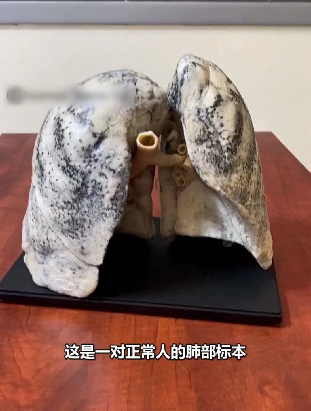 这是真正的人体尘肺标本