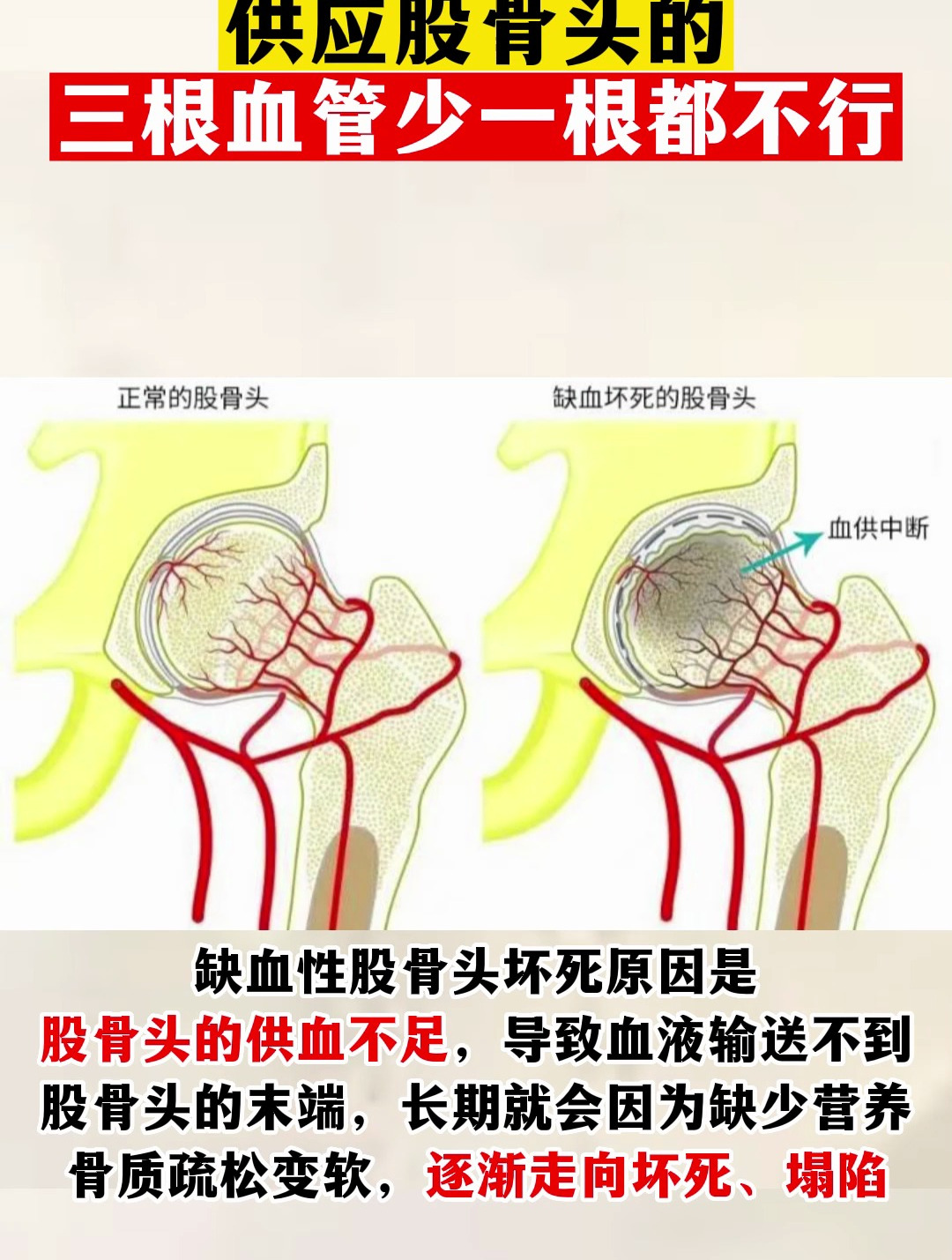 供应股骨头的三根血管少一根都不行