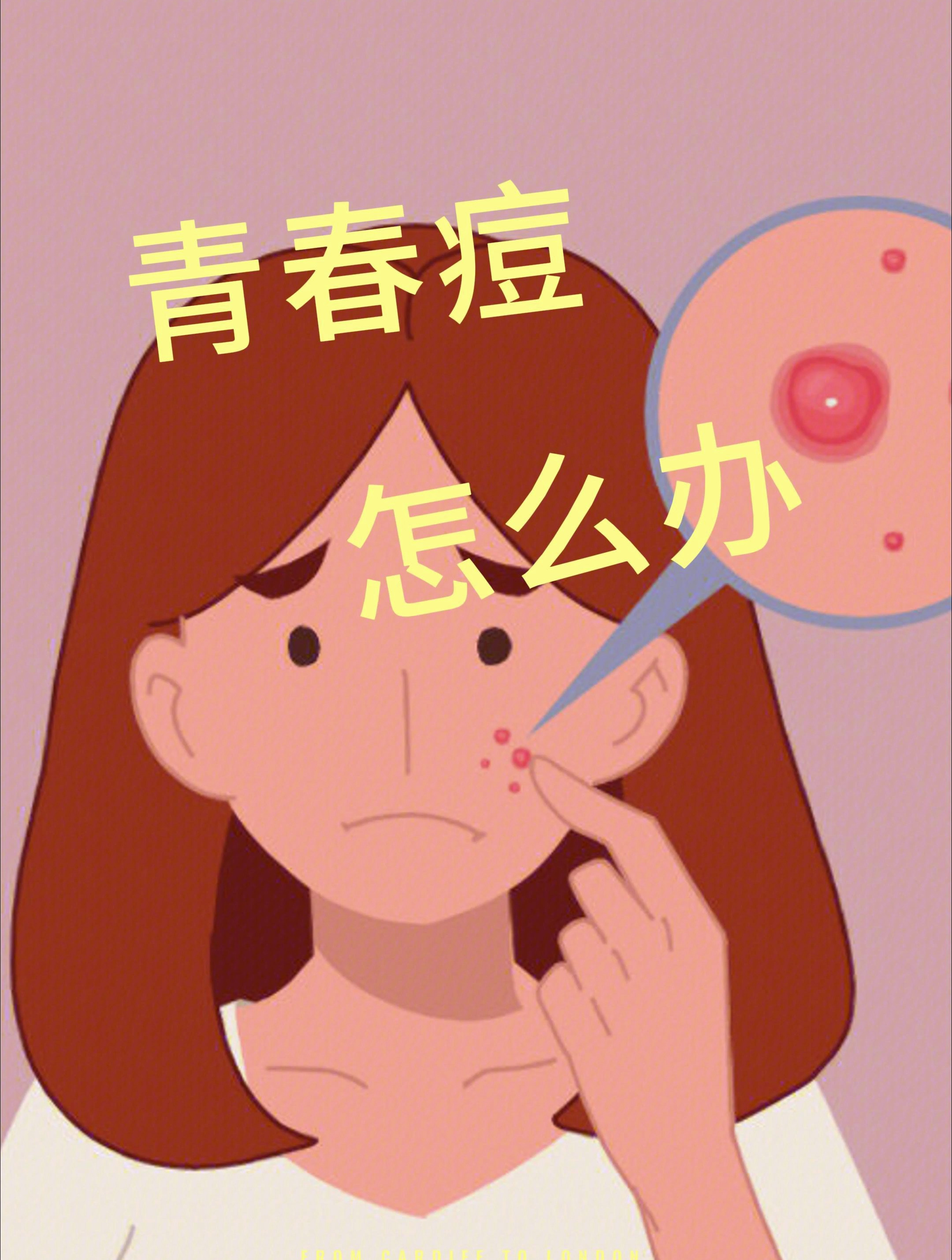 如何治疗青春痘 宜健小贴士