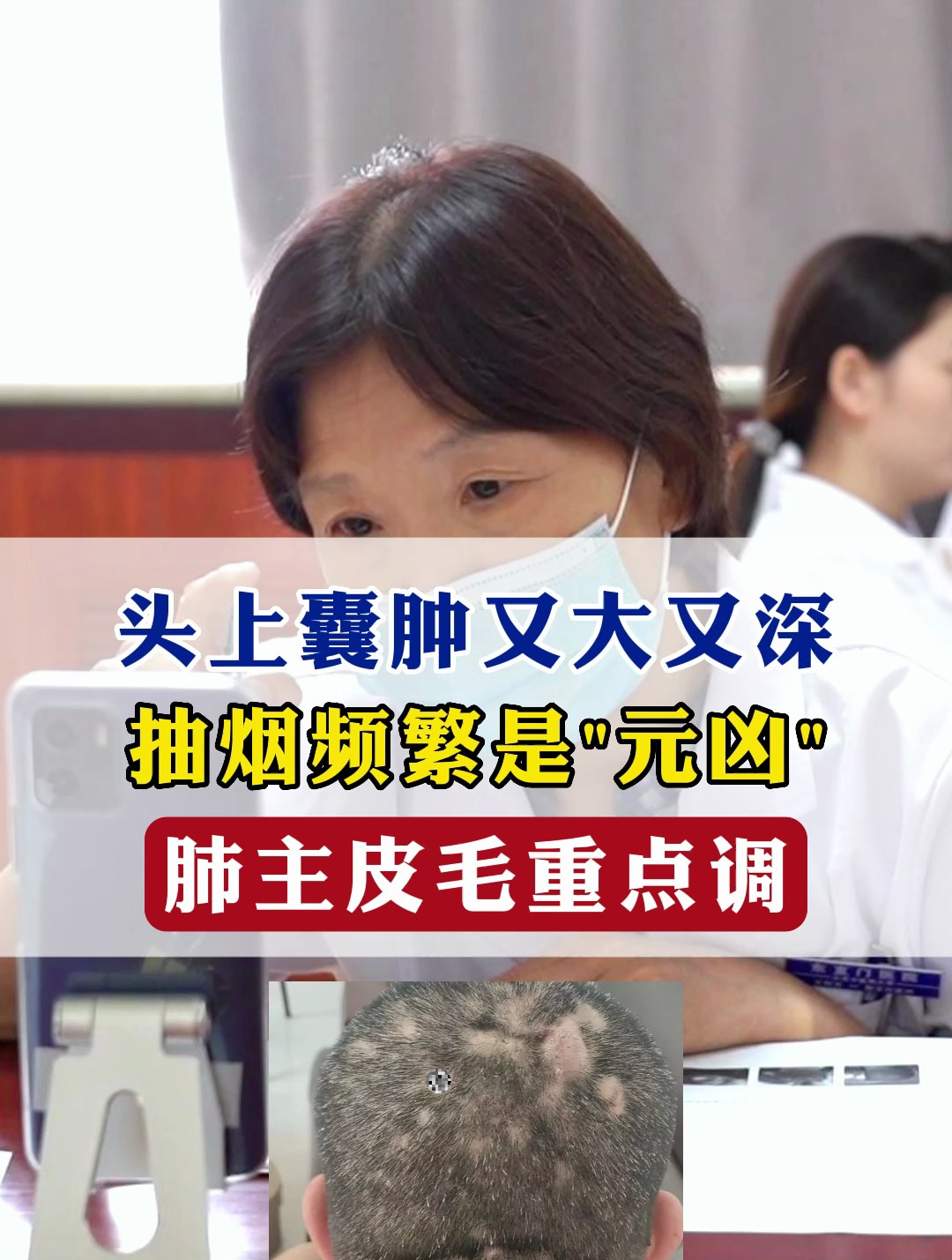 头上囊肿又大又深抽烟频繁是元凶肺主皮毛重点调