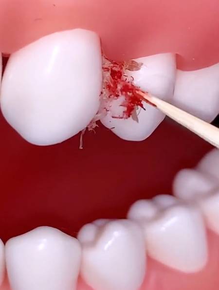 吃饭容易塞牙的,快试试这款一次性,用它剔牙快速不伤牙龈-度小视