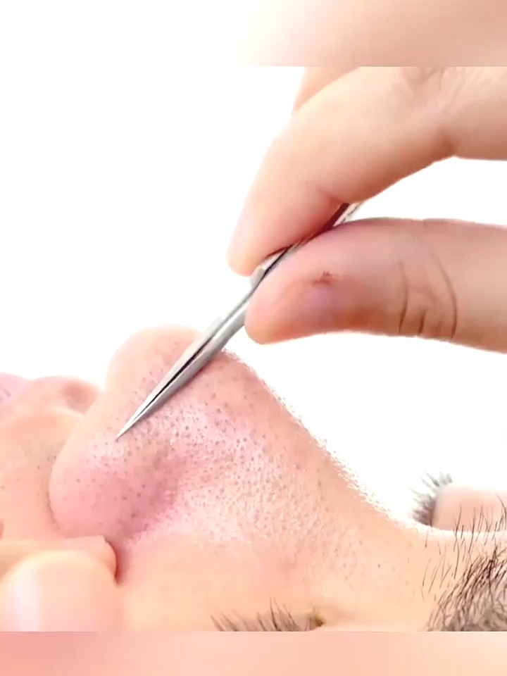 非常放松的夹黑头,通通夹出来,非常的舒适