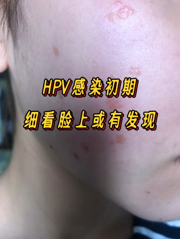 hpv感染初期,细看脸上或有发现