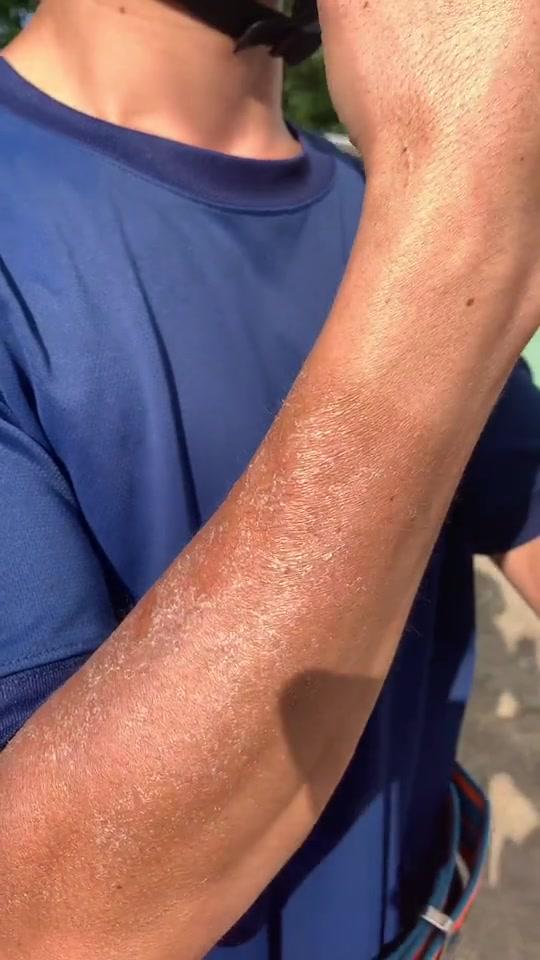 训练很辛苦,晒伤晒掉皮是常有的事情,就算如此,也要坚持训练,再苦再累