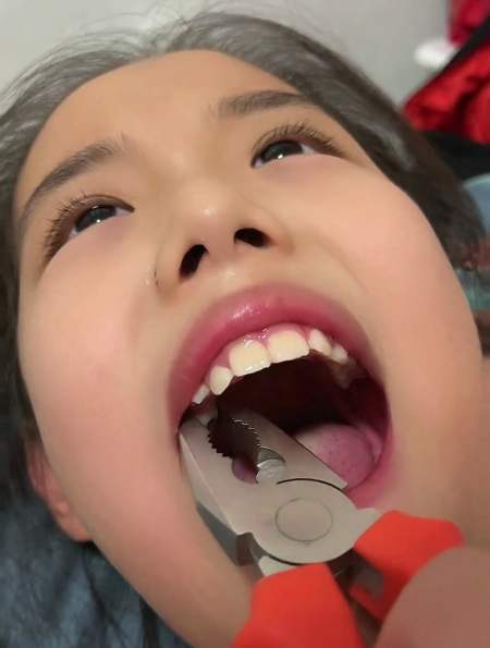 爸爸拿老虎钳给女儿拔牙,网友:身为牙医的我看呆了-度小视