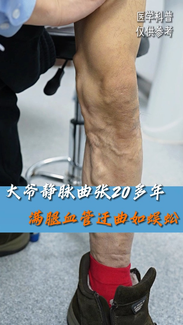 大爷静脉曲张20多年,满腿血管迂曲如蜈蚣