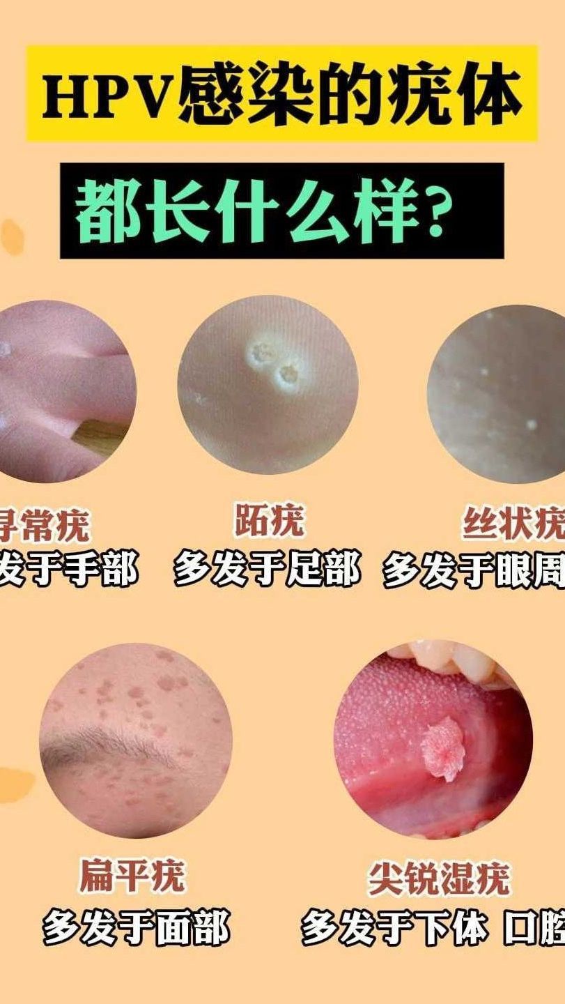 hpv感染的疣体,都长什么样?
