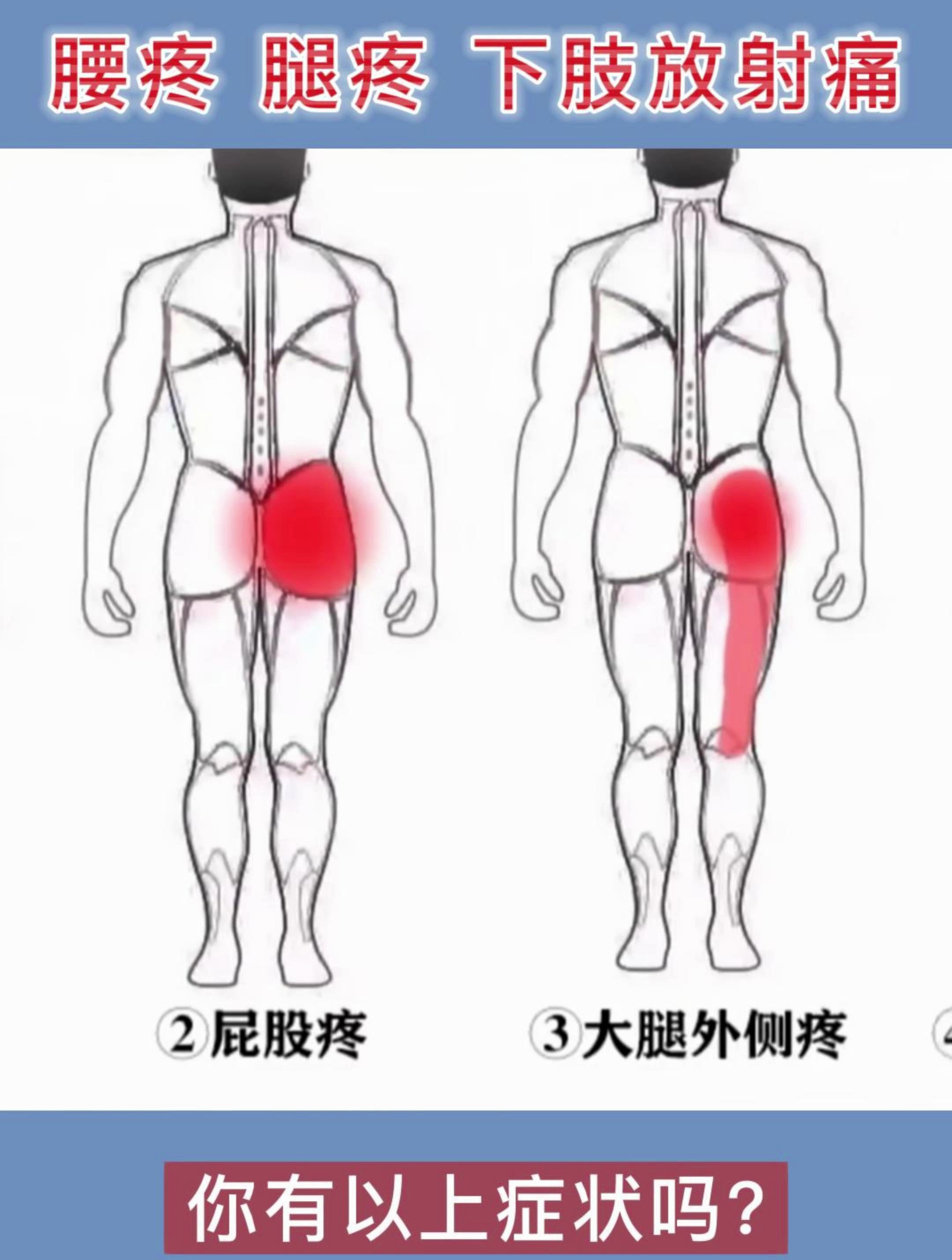 腰椎间盘突出,腰疼 腿疼 下肢放射痛!-度小视