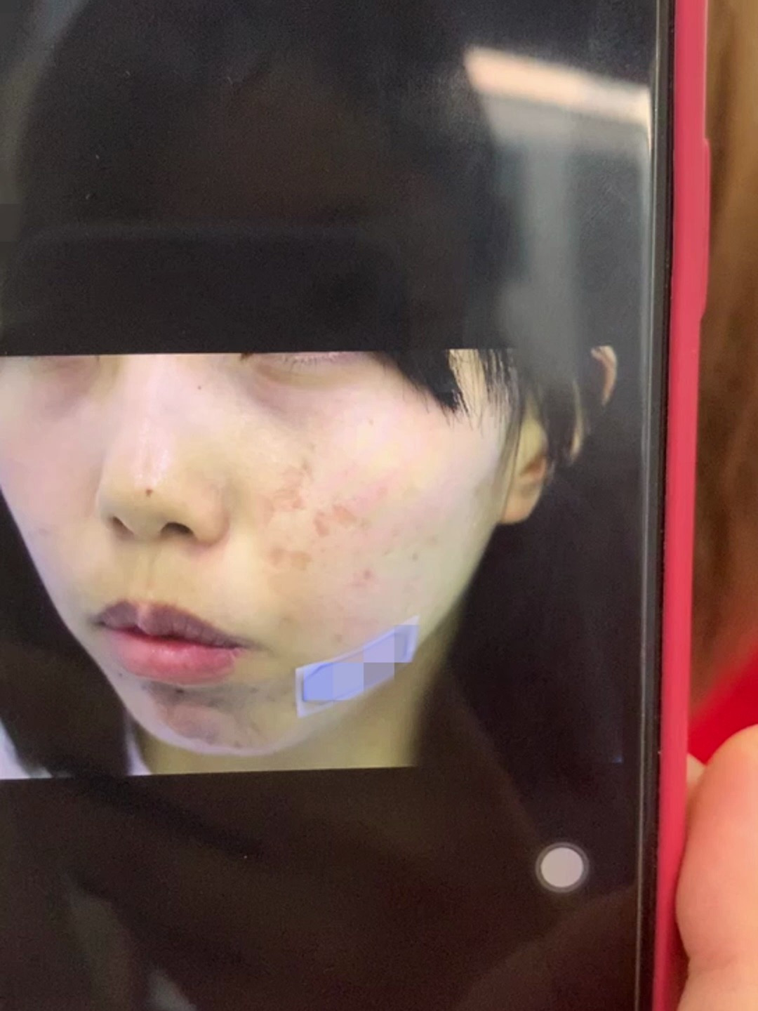 00后女孩脸部大片痘坑只因做了这件事现在没有痘坑啦