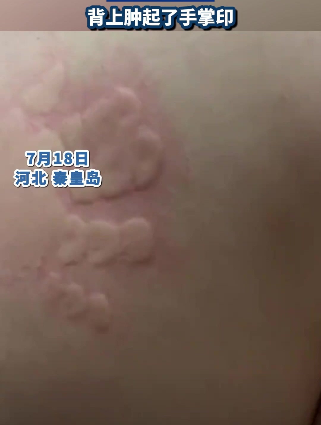 爸爸不小心惹女儿生气,被其轻拍巴掌,背上肿起了手掌印