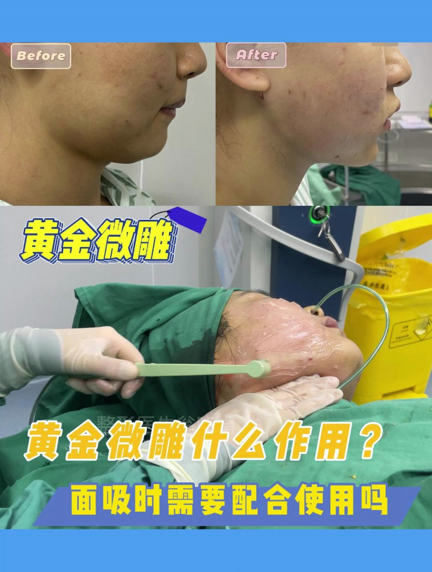 面吸的同时有必要做黄金微雕吗?