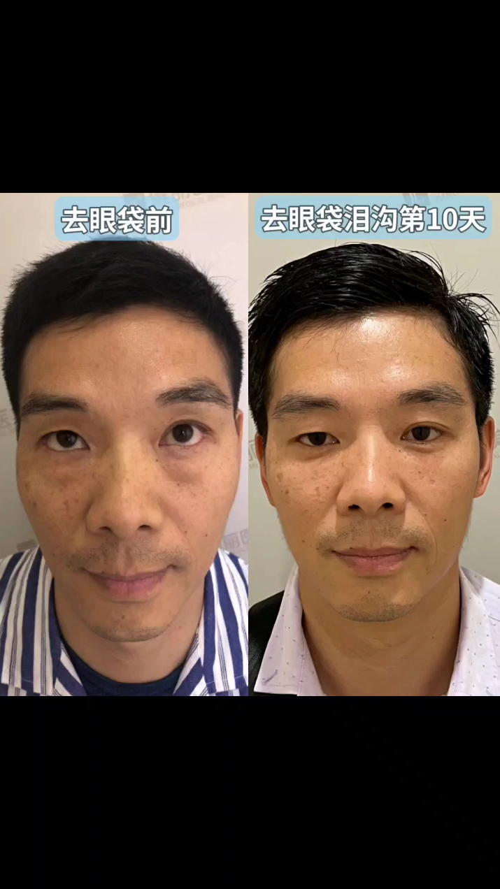 40岁男士去眼袋大变样术后10天对比明显同事都夸他变年轻了