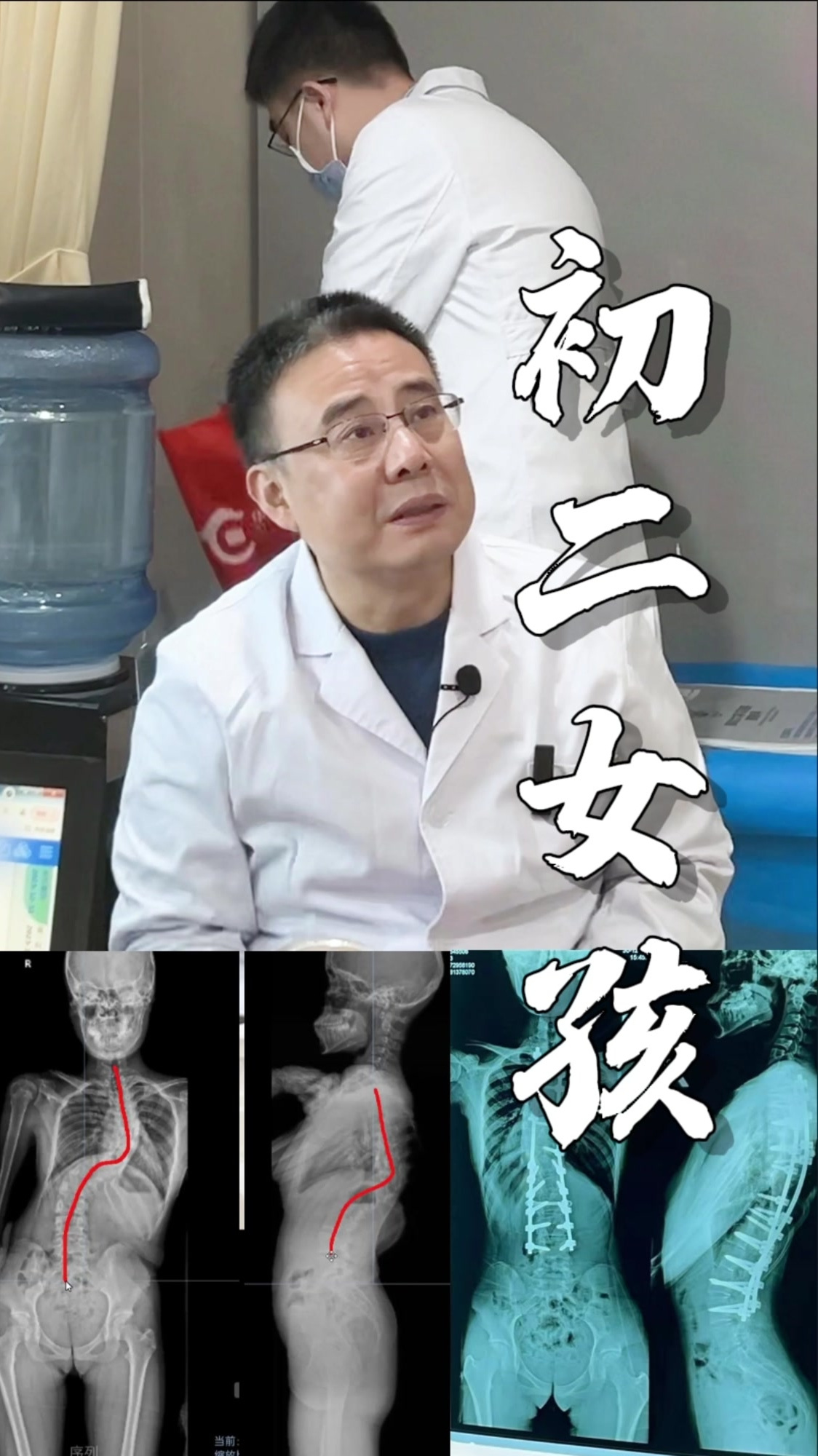 初二女孩脊柱侧弯80度术后的她可以参加中考体育测试吗