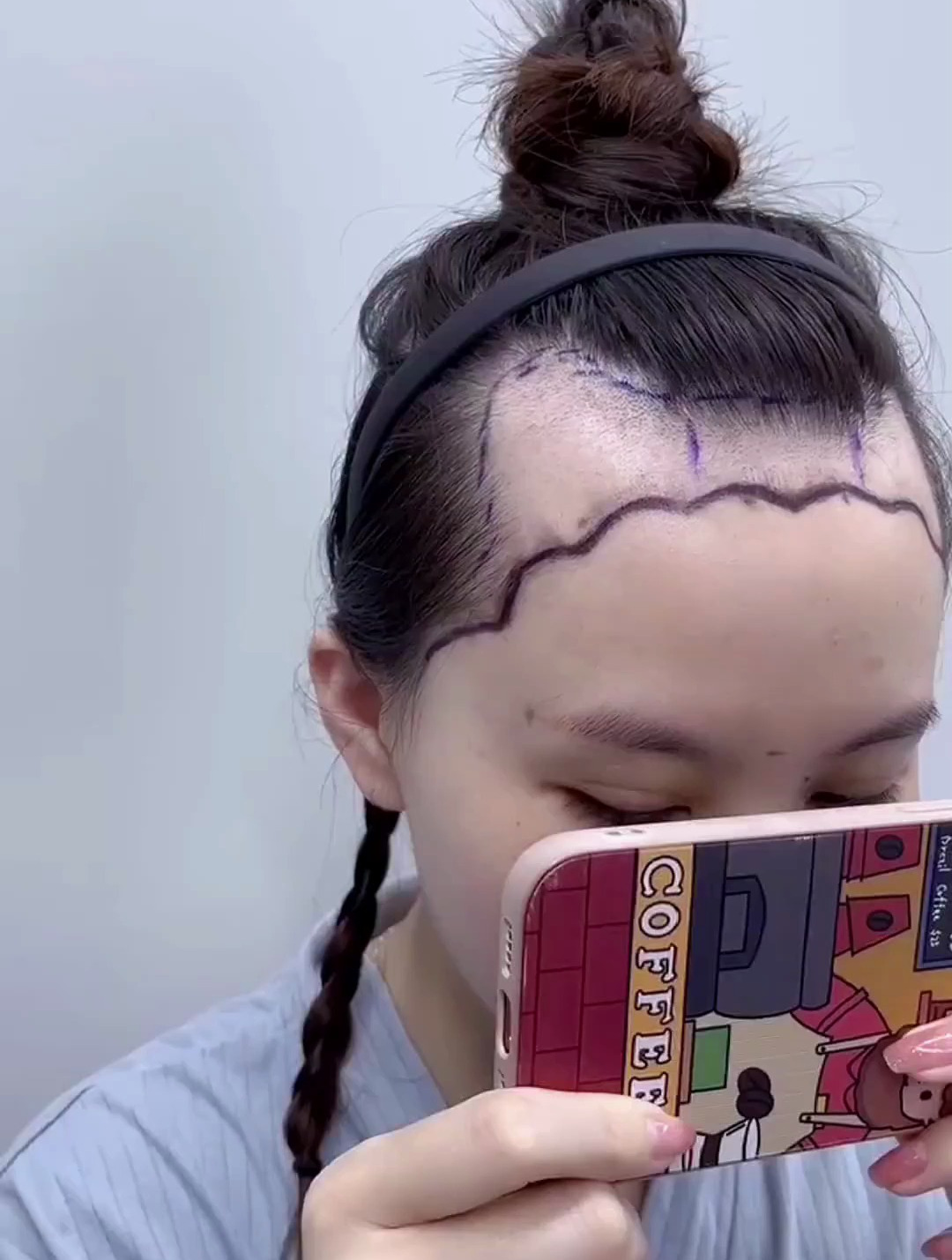 术前天生发际线高两边额角缺的比较多 设计根据顾客情况