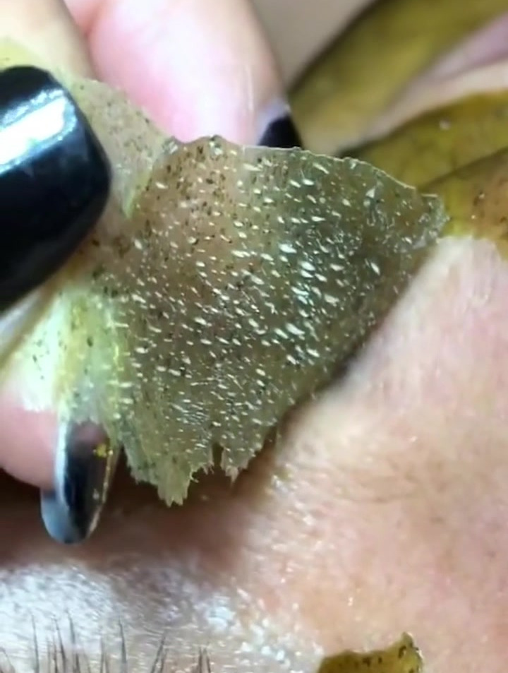 黑头粉刺一掀而起,自己被自己吓到哈哈