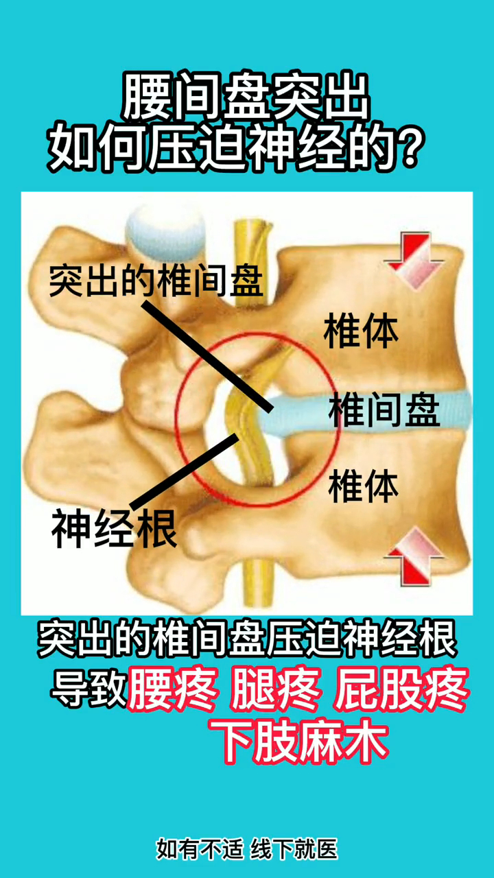 腰间盘突出疼痛位置图图片