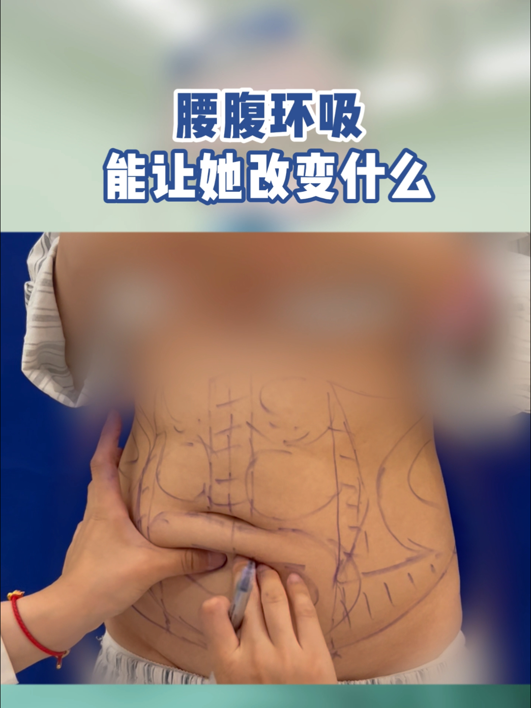 宝妈怀孕时胖了好多,腰腹环吸能让她改变什么?