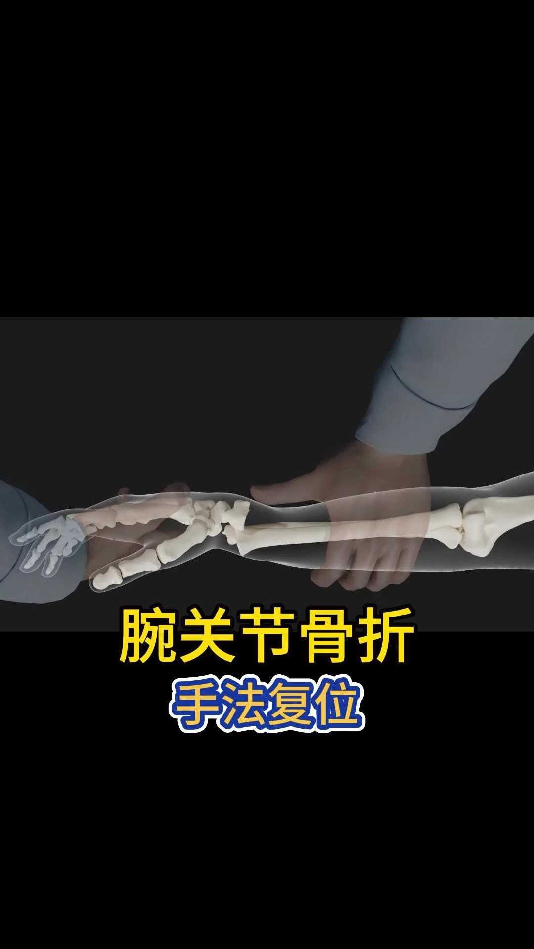 常见的腕关节骨折手法复位的动画模拟