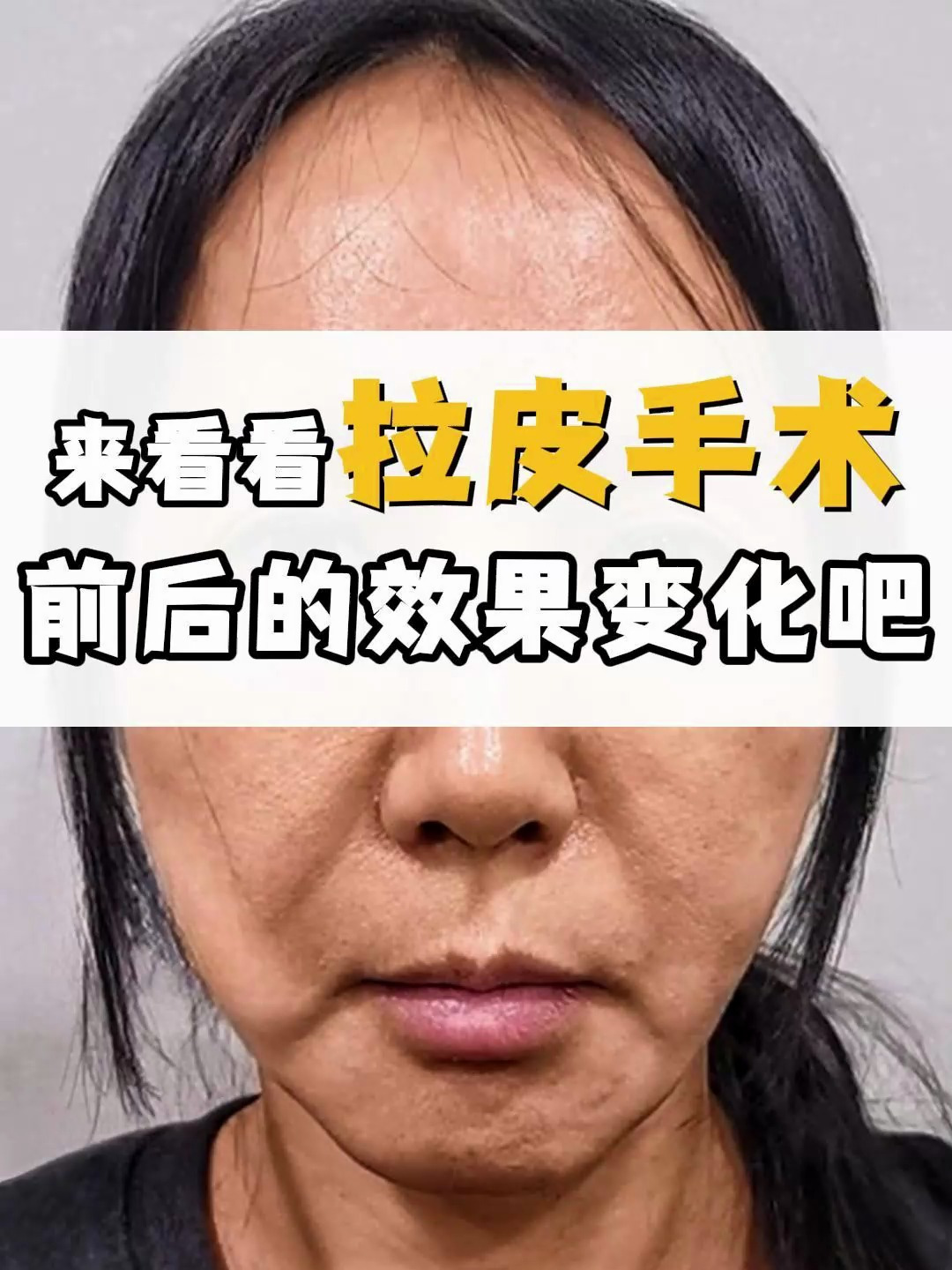 来看看拉皮手术前后变化吧