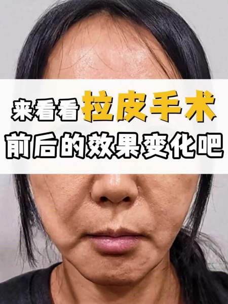 来看看拉皮手术前后变化吧