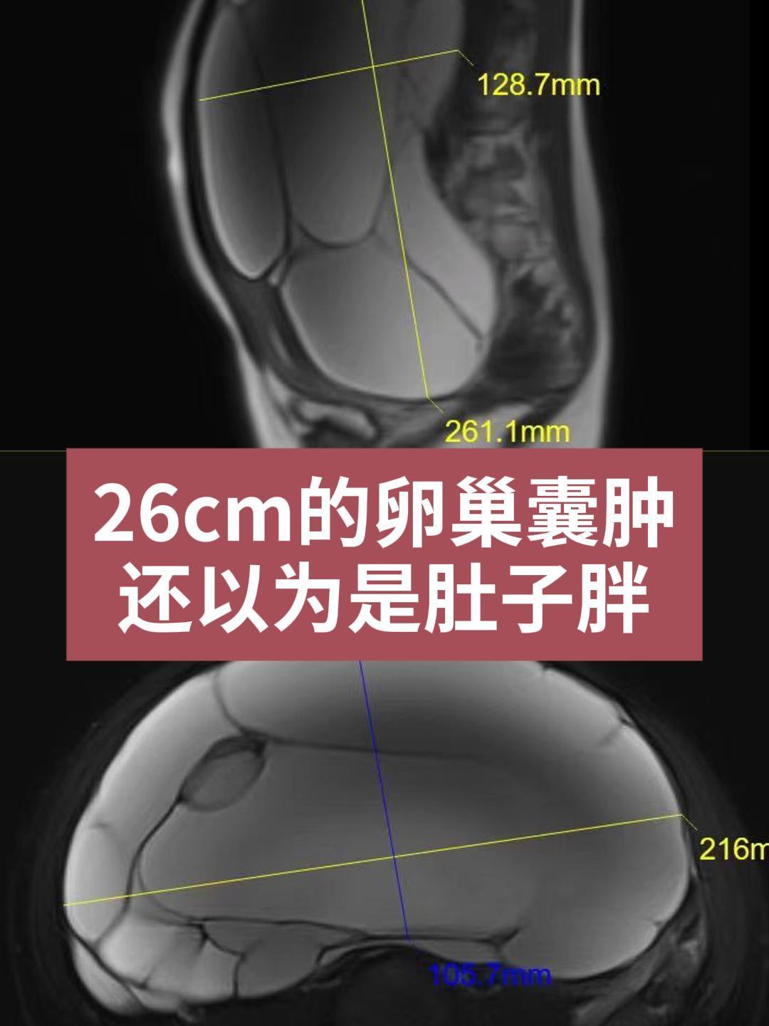 卵巢囊肿肚子变大照片图片