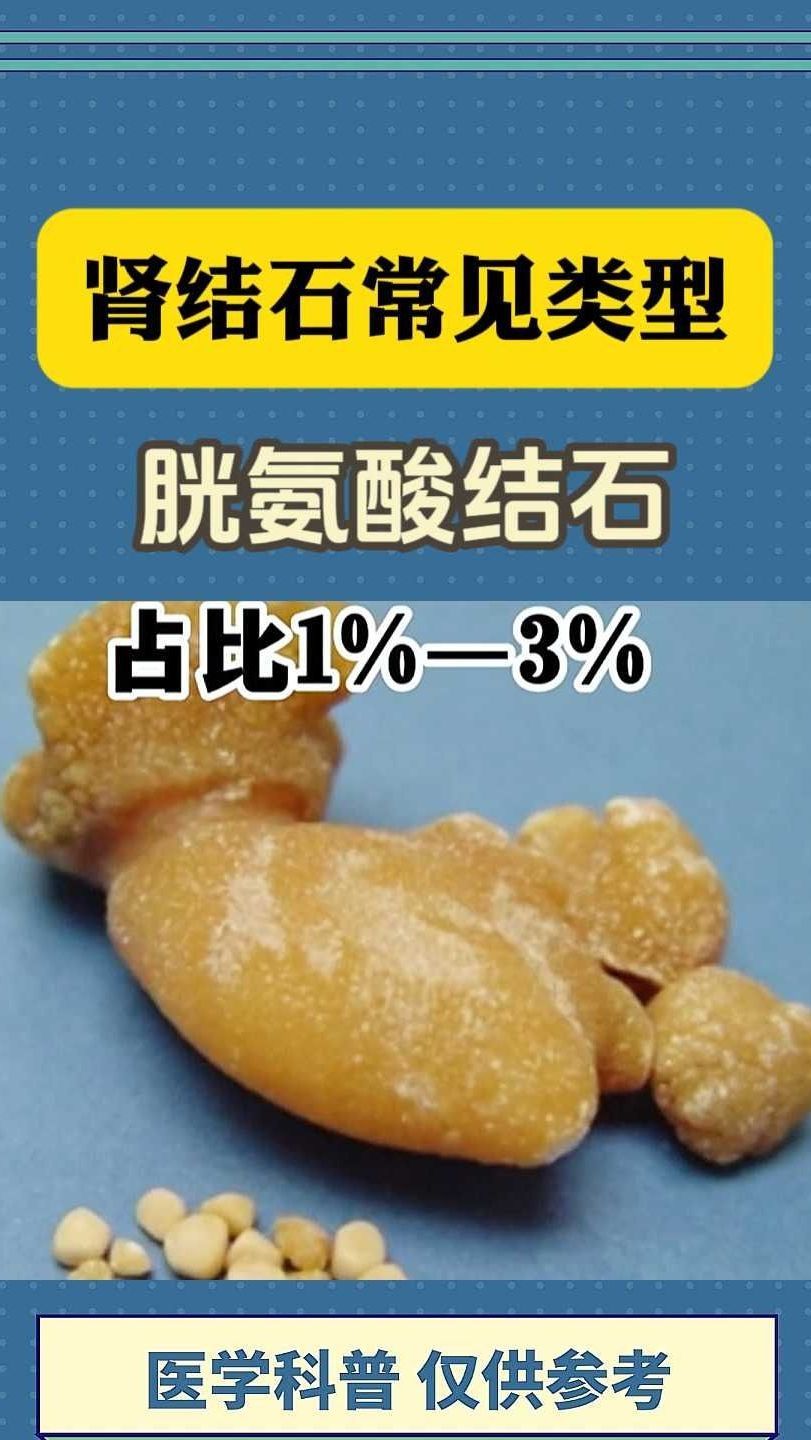 肾结石常见类型!