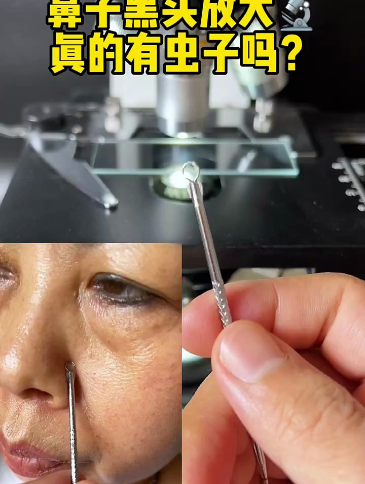 显微镜下的黑头粉刺螨虫痘痘