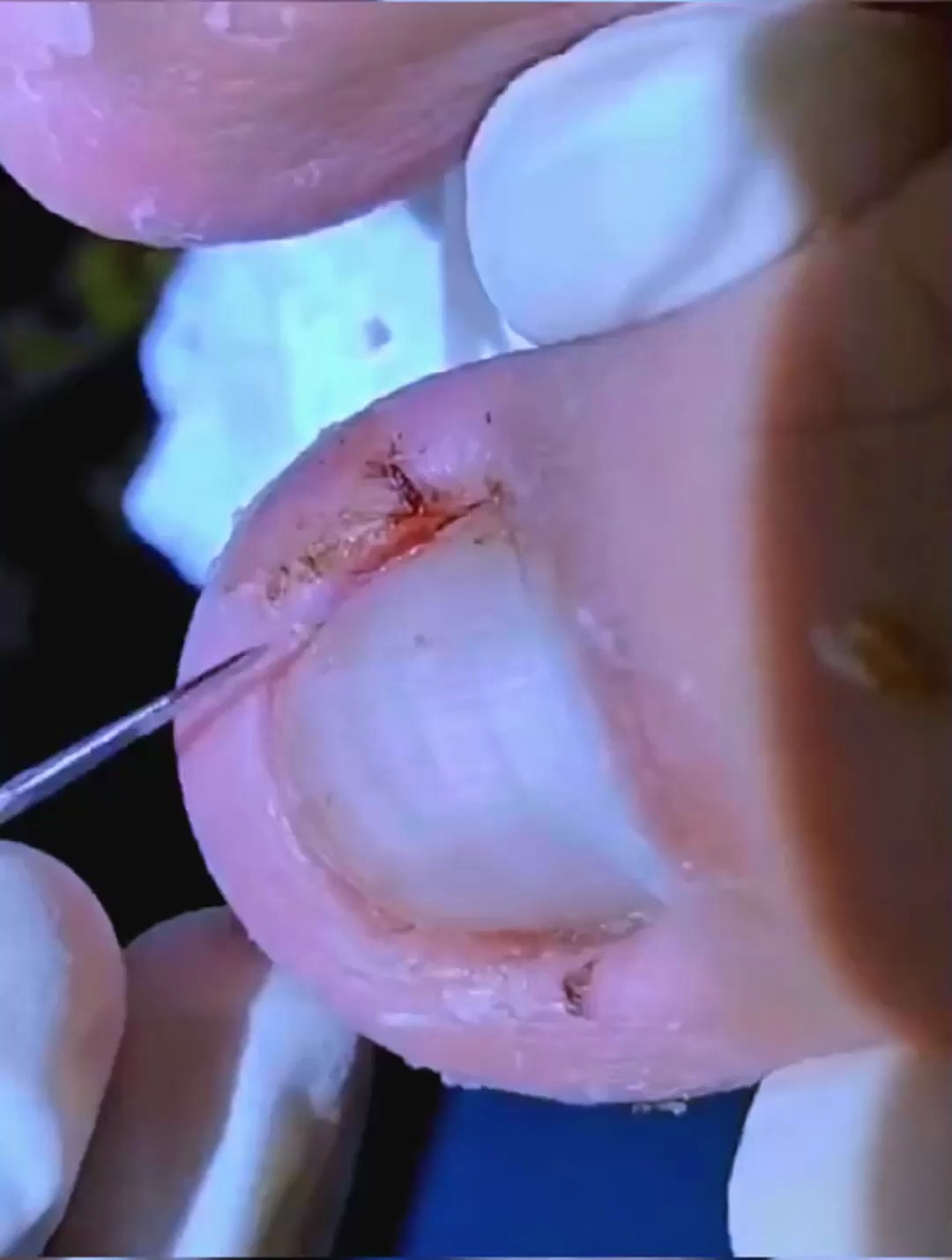 小伙指甲嵌进肉里,导致脚趾都肿了起来,取出嵌甲就好多了